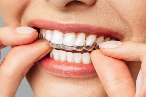Clear Aligner